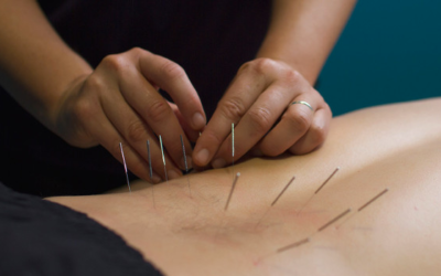 Dry Needling:  Terrifying in Name, Reliable in Pain Relief