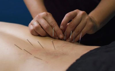 How Dry Needling Relieves Pain